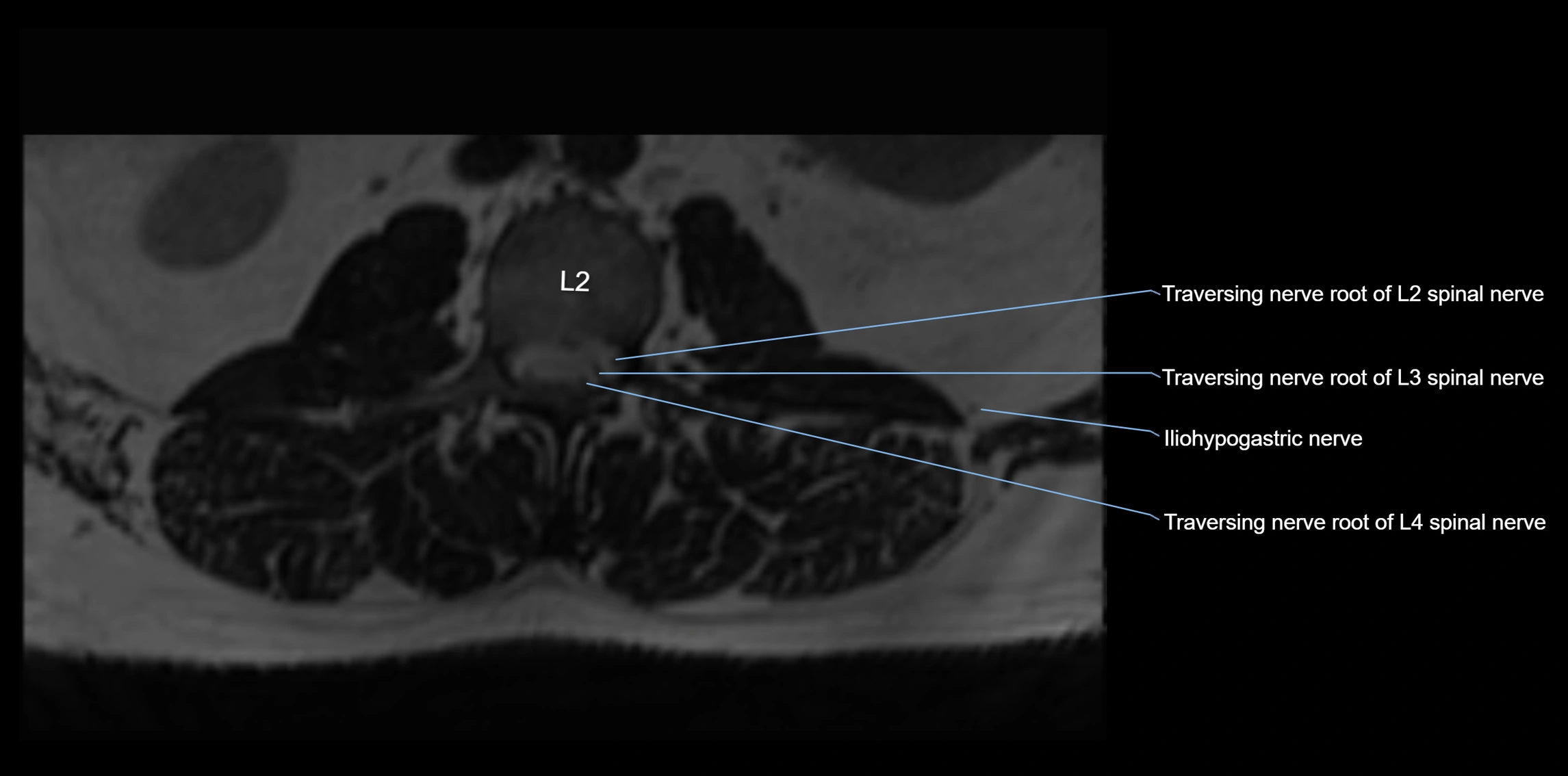 MR lumbosacral plexus axial cross sectional anatomy 3T  radiology  image-img-1008001-00003.webp